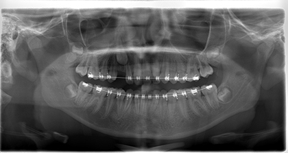 Exposure and bonding of impacted tooth - before