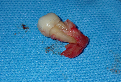 An infected tooth requiring extraction