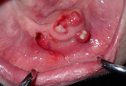 Underlying infection of the jaw bone