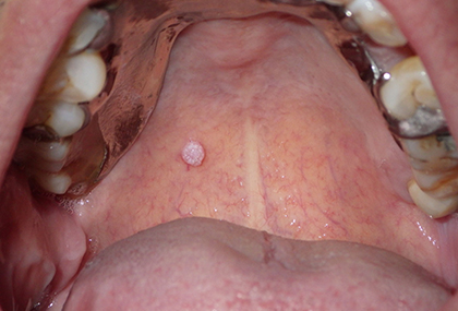 Roof of mouth pathology
