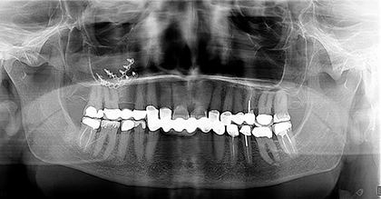 A cheek fracture fixed with plates and screws