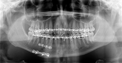 A jaw fracture fixed with plates and screws