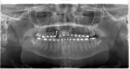 Exposure and bonding of impacted tooth - after