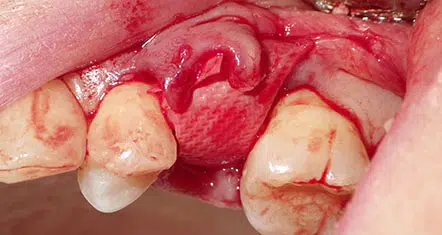 After placement of bone graft with membrane