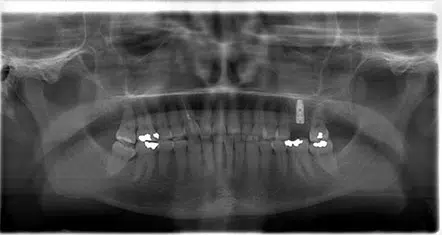 Immediate placement of implant (same day as extraction) - after