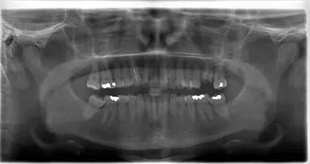 Immediate placement of implant (same day as extraction) - before