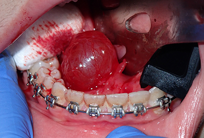 Lesion floor of mouth